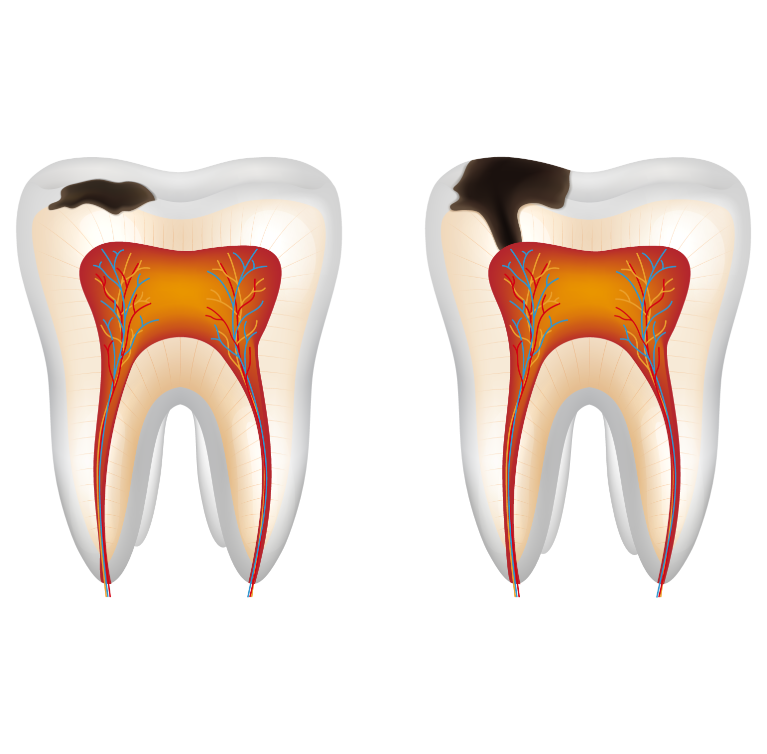 Cavities - Orange Dental Inc