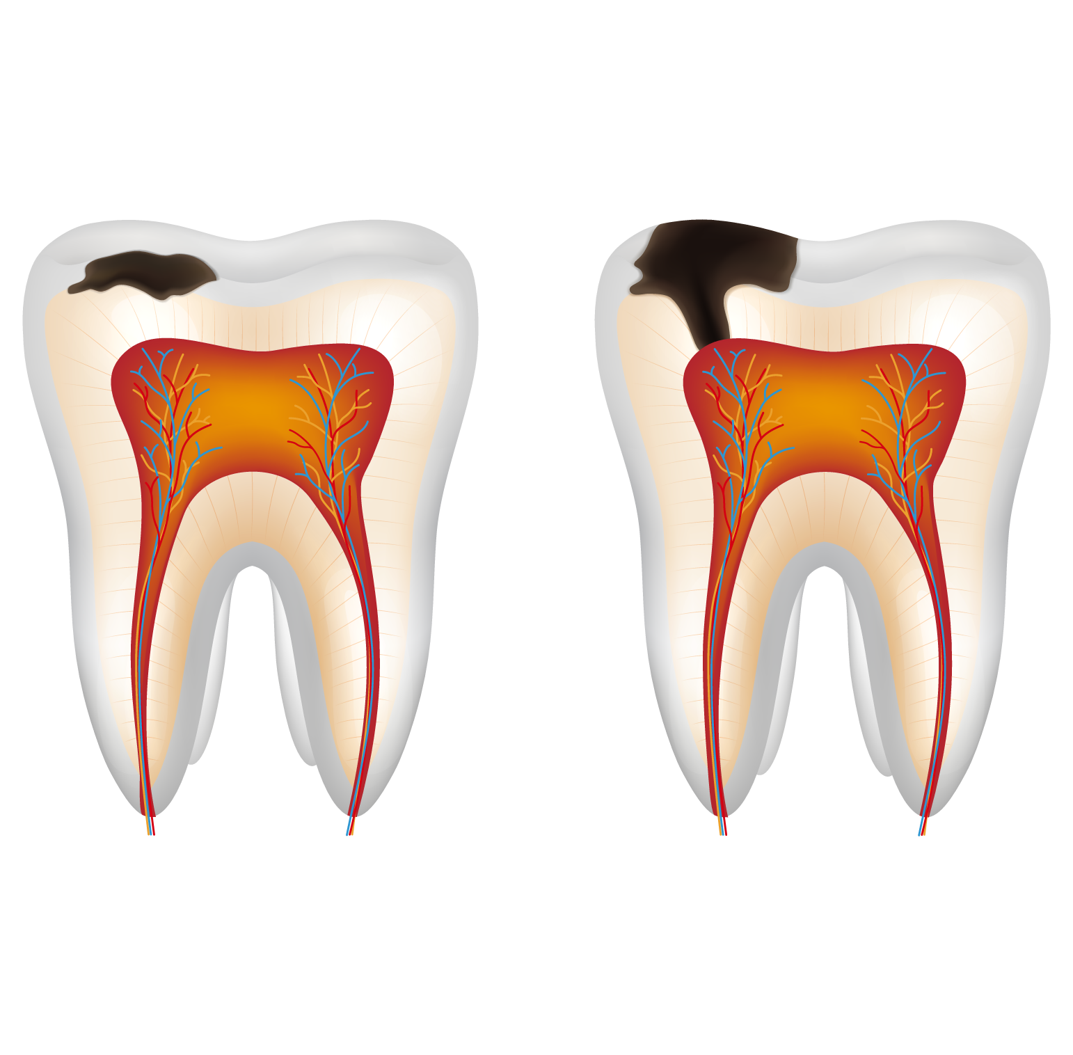 Cavities Treatment & Prevention | Orange Dental Clinic