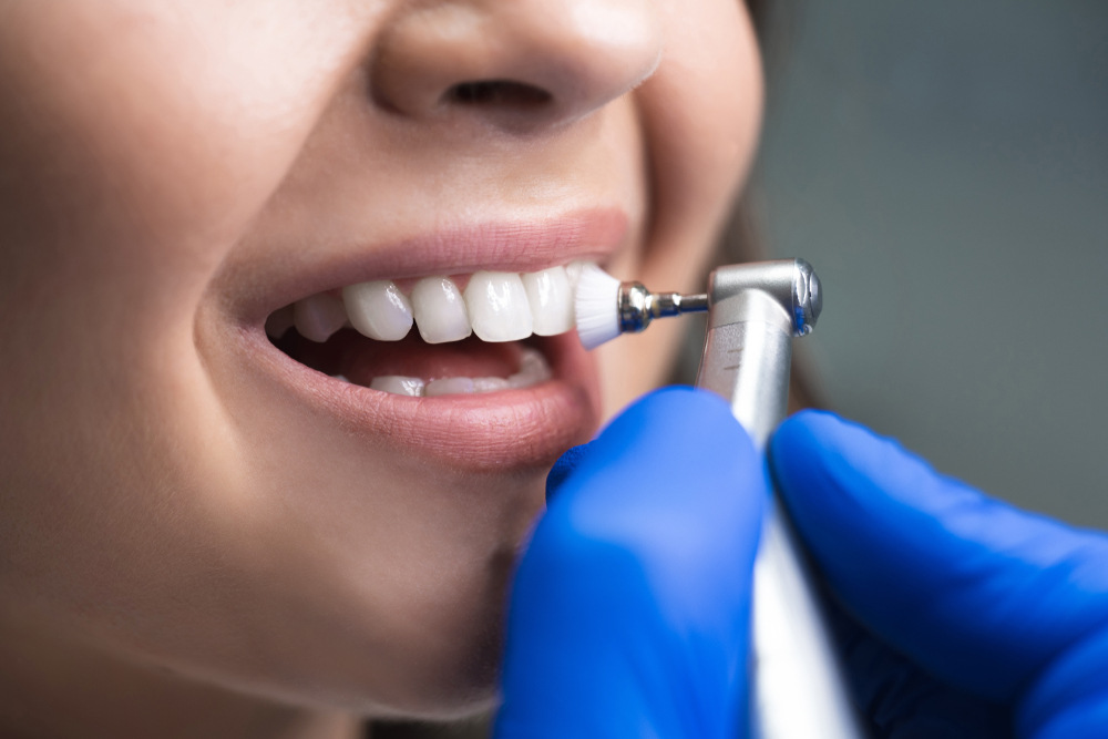 Exploring the Benefits of Professional Teeth Whitening Services