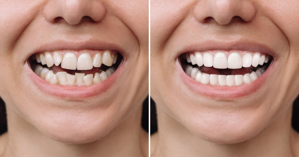 Cosmetic Dental Bonding: Procedures, Types, and Benefits