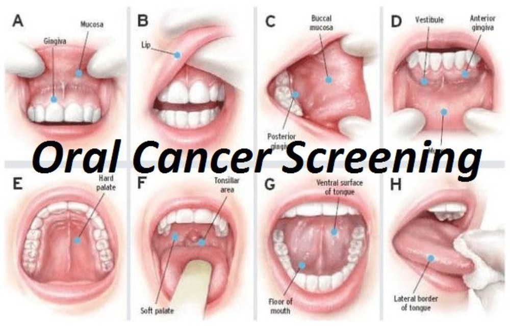 oral cancer screening