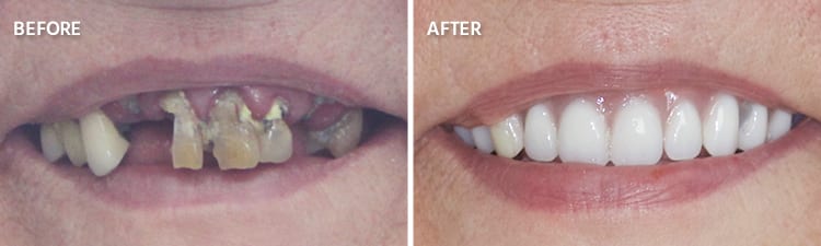 Full Mouth Reconstruction: Methods, Supplies, And Outcomes