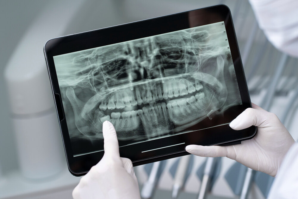 The Importance of Dental X-Rays in Oral Health