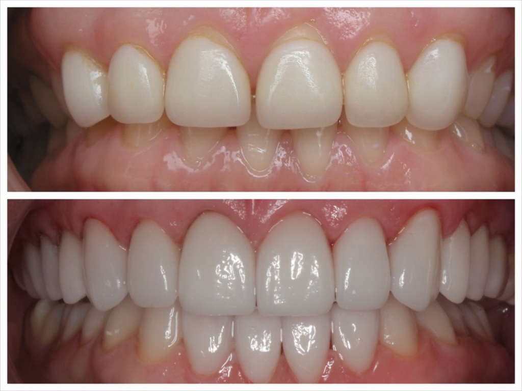 How a Porcelain Veneers Specialist Enhances Dental Aesthetics
