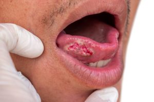 oral cancer treatment