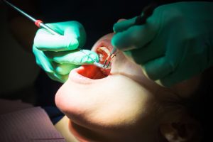 Wisdom Tooth Extraction