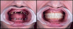 full mouth dental implant