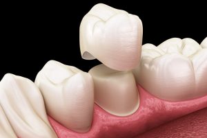 cerec dental crown