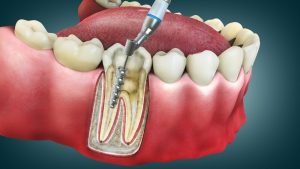 root canal treatment