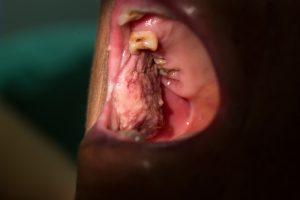 Oral Cancer Treatment