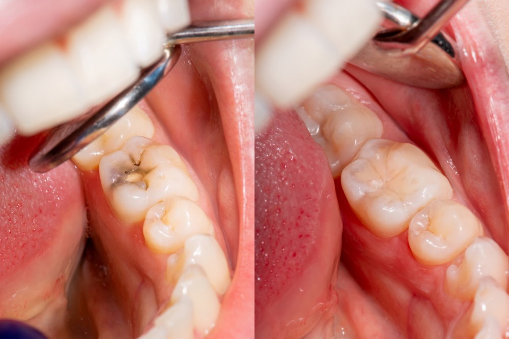 Root Canal Treatment