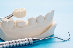 Dental Implants Over Dentures